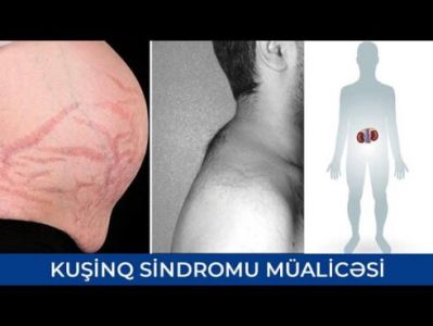 "Kuşinq" sindromu nədir? Simptomlar və müalicələri hansılardır?